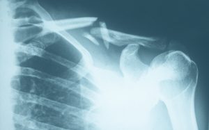 Röntgenbild eines Schlüsselbeinbruches links